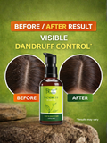Visible dandruff control results before and after using Trinabha Ayurvedic Hair Oil on a dry scalp